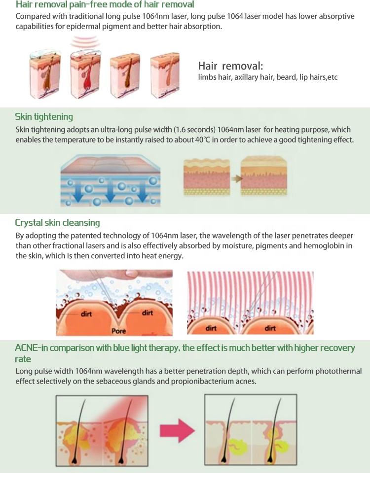 光纤脱毛机 - SMIO #145 - Professional 808nm Diode Laser equipment by SMIO