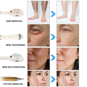 IPL Skin Rejuvenation Machine
