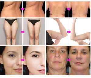 Body Contouring Before After