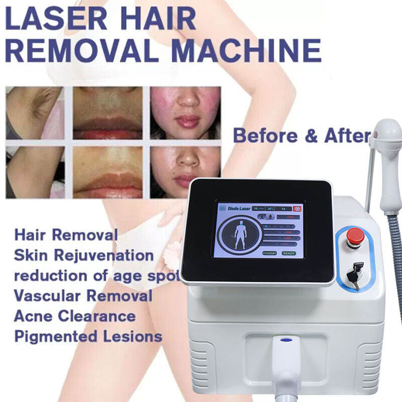 台式808 - SMIO #180 - Professional 808nm Diode Laser equipment by SMIO