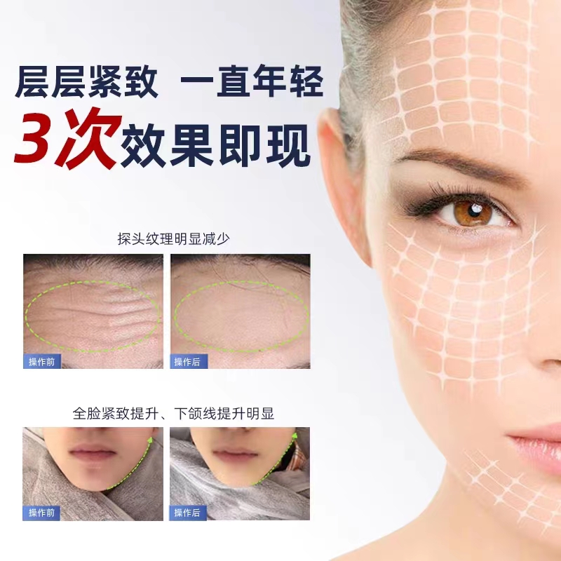 热玛吉 - SMIO #203 - Professional RF / Thermage / Skin Tightening equipment by SMIO