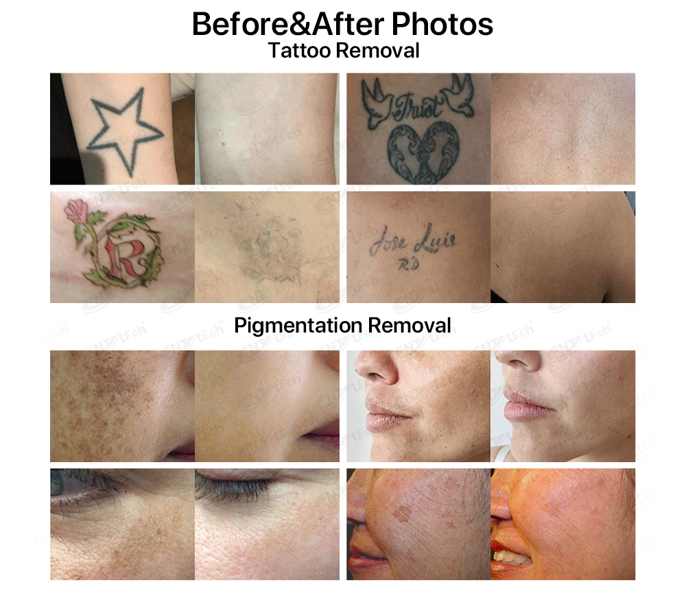 新款超皮秒 - SMIO #213 - Professional Picosecond / CO2 / Nd:YAG Laser equipment by SMIO