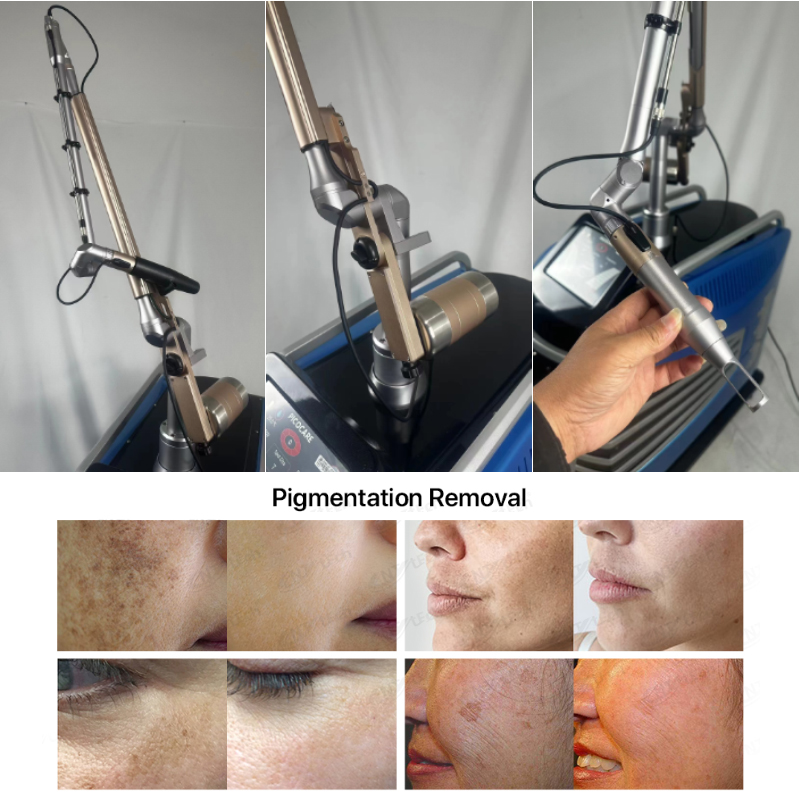 新款超皮秒 - SMIO #213 - Professional Picosecond / CO2 / Nd:YAG Laser equipment by SMIO