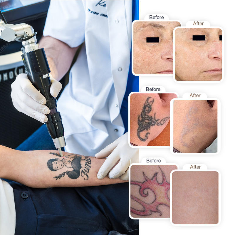 台式超皮秒 - SMIO #236 - Professional Picosecond / CO2 / Nd:YAG Laser equipment by SMIO