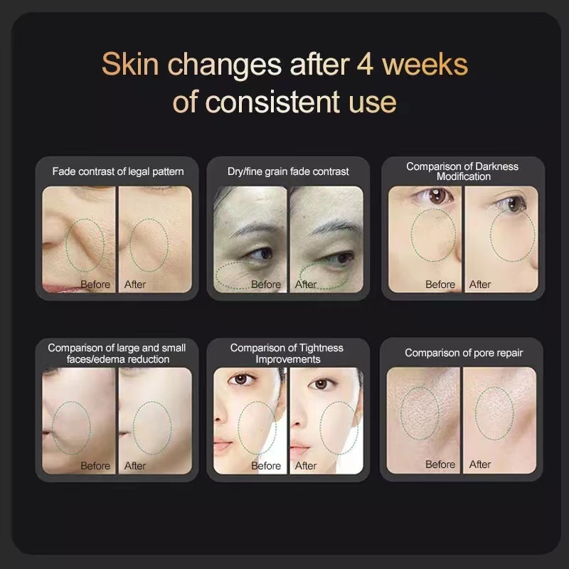 手持 胶原炮 - SMIO #240 - Professional RF Microneedle / Collagen Gun equipment by SMIO