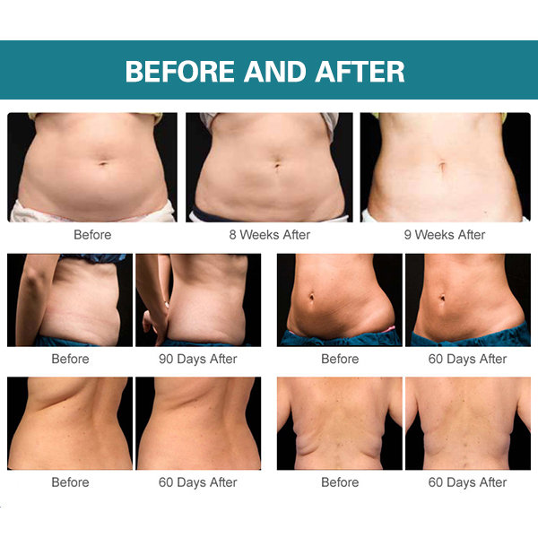 BTL 射频溶脂 - SMIO #307 - Professional Body Sculpting / Fat Reduction equipment by SMIO