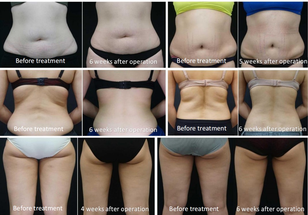 360冷冻机 - SMIO #312 - Professional Body Sculpting / Fat Reduction equipment by SMIO