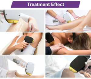 808nm Diode Hair Removal Device