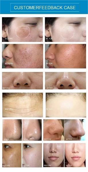黑珍珠10手柄 - SMIO #328 - Professional Professional Beauty Equipment equipment by SMIO
